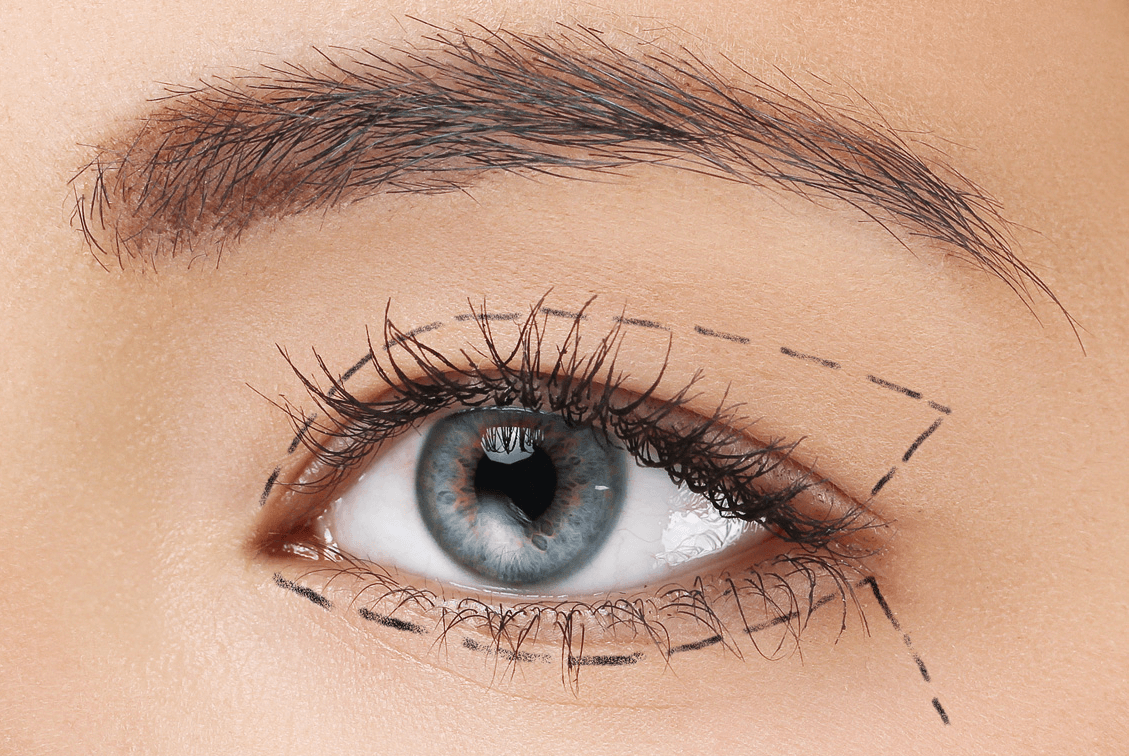 Blépharoplastie Nice