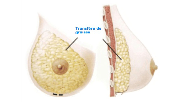 Lipofilling Seins Nice