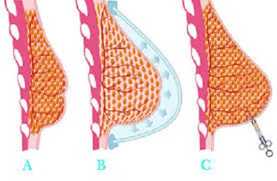augmentation par lipofilling mammaire