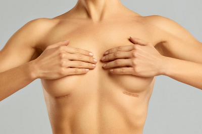 cicatrices chirurgie mammaire