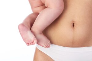liposuccion-avant-grossesse