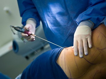 Liposuccion Nice
